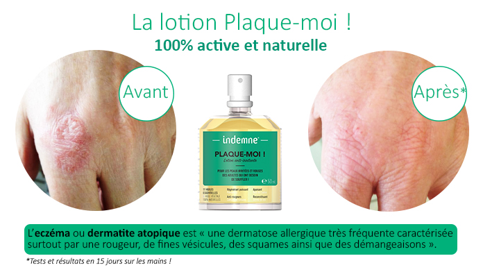 Lotion anti-irritations de la peau résultat avant après